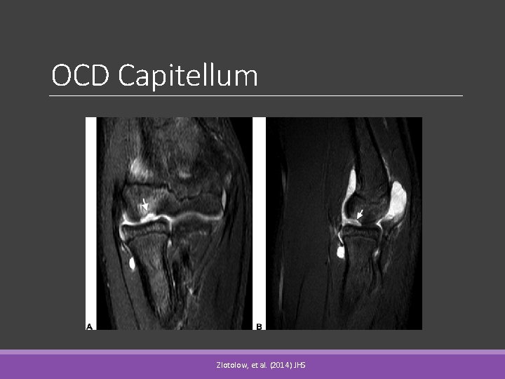 OCD Capitellum Zlotolow, et al. (2014) JHS 