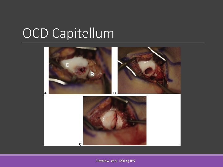 OCD Capitellum Zlotolow, et al. (2014) JHS 