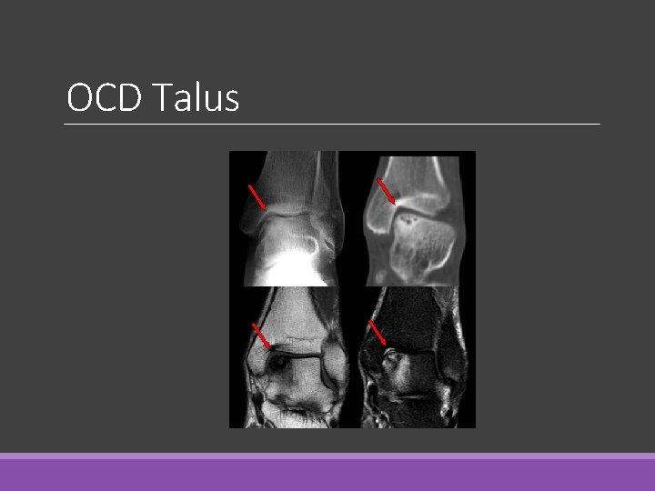 OCD Talus 