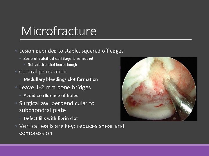 Microfracture ◦ Lesion debrided to stable, squared off edges ◦ Zone of calcified cartilage Microfracture ◦ Lesion debrided to stable, squared off edges ◦ Zone of calcified cartilage
