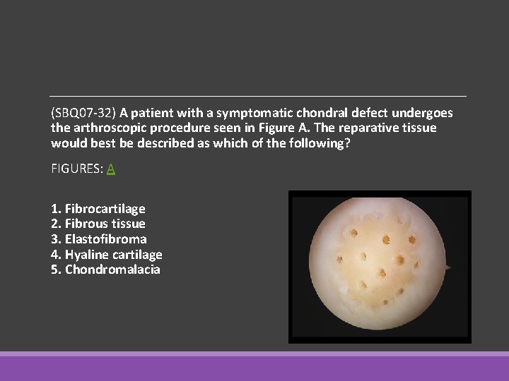 (SBQ 07 -32) A patient with a symptomatic chondral defect undergoes the arthroscopic procedure