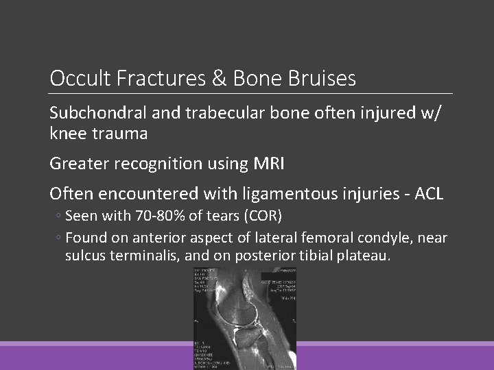 Occult Fractures & Bone Bruises Subchondral and trabecular bone often injured w/ knee trauma Occult Fractures & Bone Bruises Subchondral and trabecular bone often injured w/ knee trauma