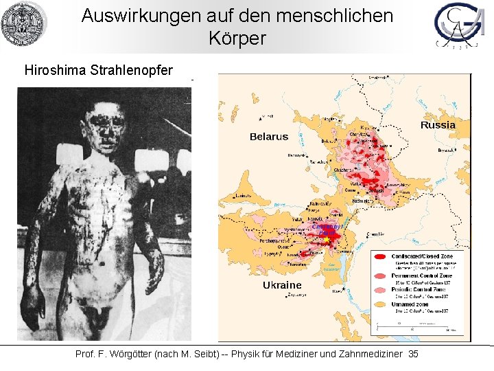 Auswirkungen auf den menschlichen Körper Hiroshima Strahlenopfer Prof. F. Wörgötter (nach M. Seibt) --