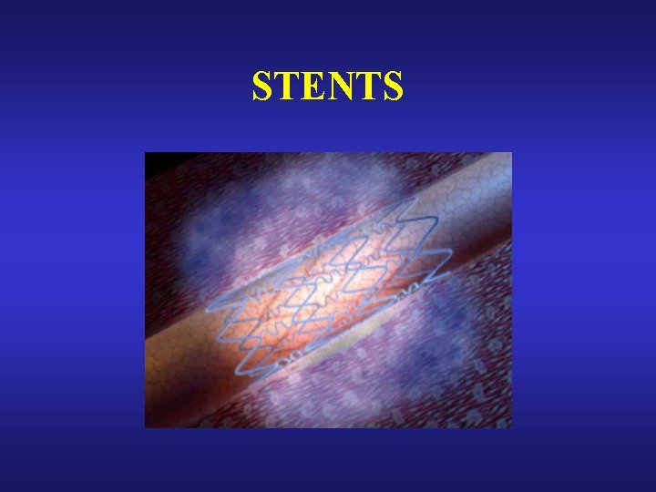 STENTS STENTS