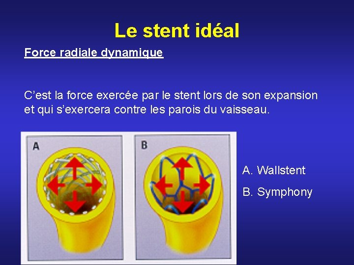 Le stent idéal Force radiale dynamique C’est la force exercée par le stent lors Le stent idéal Force radiale dynamique C’est la force exercée par le stent lors