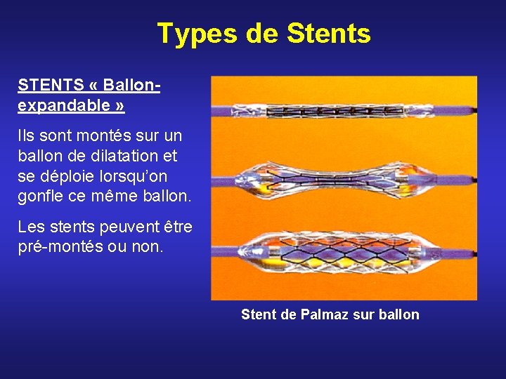Types de Stents STENTS « Ballonexpandable » Ils sont montés sur un ballon de Types de Stents STENTS « Ballonexpandable » Ils sont montés sur un ballon de