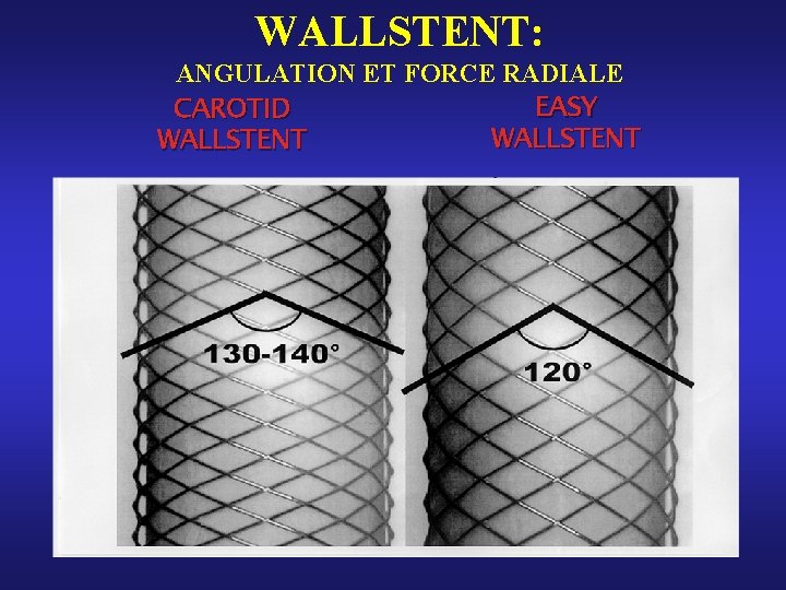 WALLSTENT: ANGULATION ET FORCE RADIALE EASY CAROTID WALLSTENT WALLSTENT: ANGULATION ET FORCE RADIALE EASY CAROTID WALLSTENT
