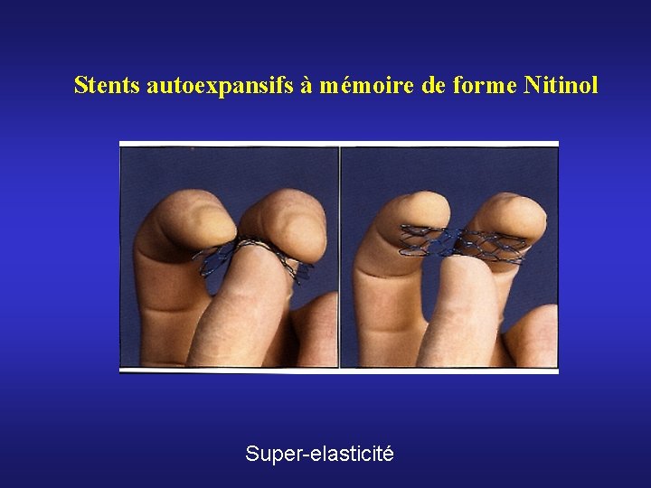 Stents autoexpansifs à mémoire de forme Nitinol Super-elasticité Stents autoexpansifs à mémoire de forme Nitinol Super-elasticité