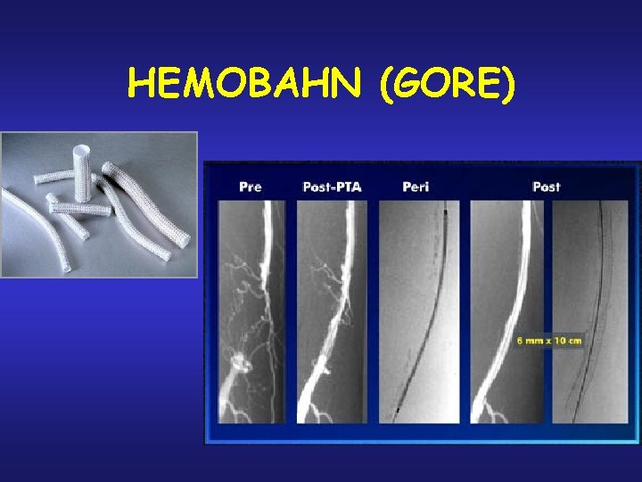 HEMOBAHN (GORE) HEMOBAHN (GORE)