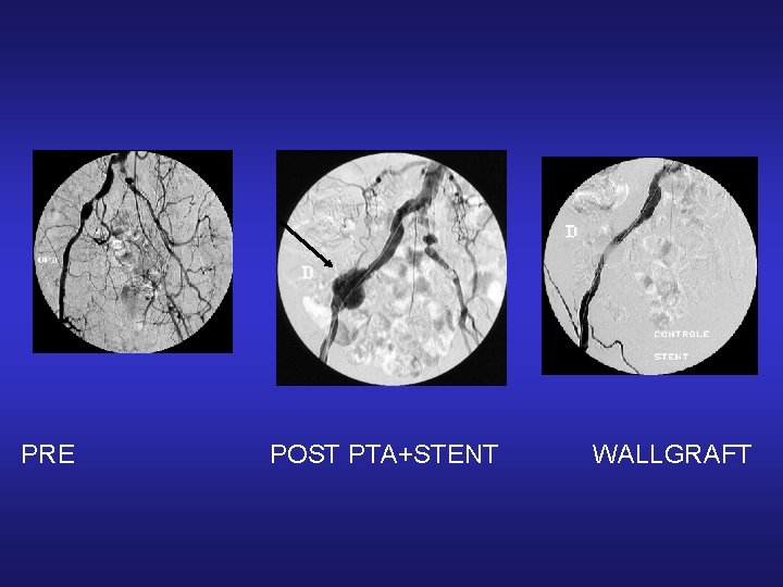 PRE POST PTA+STENT WALLGRAFT PRE POST PTA+STENT WALLGRAFT