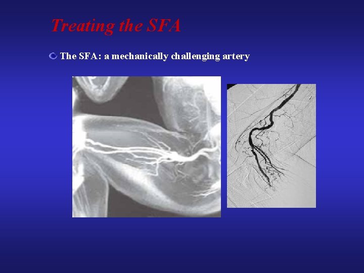 Treating the SFA The SFA: a mechanically challenging artery Treating the SFA The SFA: a mechanically challenging artery