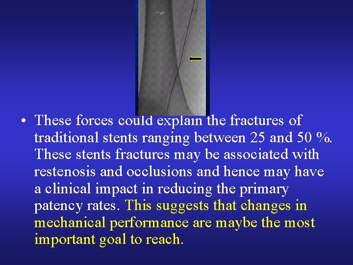 • These forces could explain the fractures of traditional stents ranging between 25 • These forces could explain the fractures of traditional stents ranging between 25
