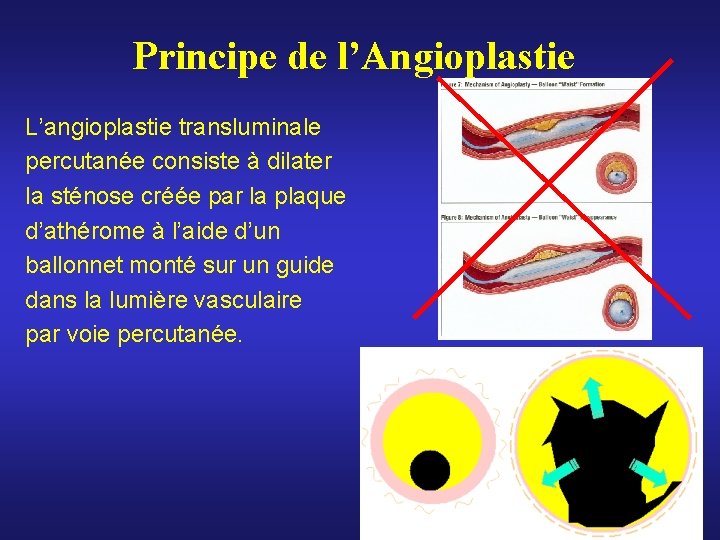 Principe de l’Angioplastie L’angioplastie transluminale percutanée consiste à dilater la sténose créée par la Principe de l’Angioplastie L’angioplastie transluminale percutanée consiste à dilater la sténose créée par la
