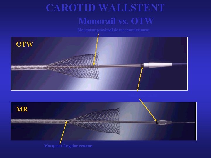 CAROTID WALLSTENT Monorail vs. OTW Marqueur proximal de raccourcissement OTW Marqueur distal MR Marqueur CAROTID WALLSTENT Monorail vs. OTW Marqueur proximal de raccourcissement OTW Marqueur distal MR Marqueur