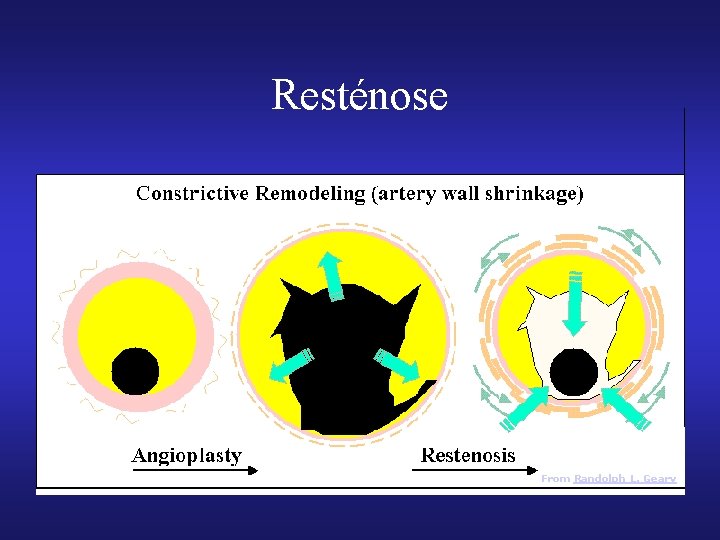 Resténose From Randolph L. Geary Resténose From Randolph L. Geary
