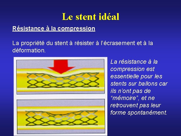 Le stent idéal Résistance à la compression La propriété du stent à résister à Le stent idéal Résistance à la compression La propriété du stent à résister à