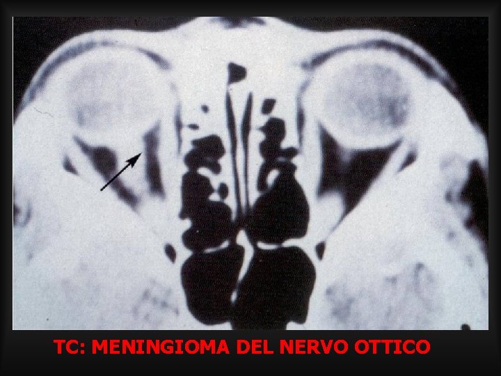 TC: MENINGIOMA DEL NERVO OTTICO TC: MENINGIOMA DEL NERVO OTTICO
