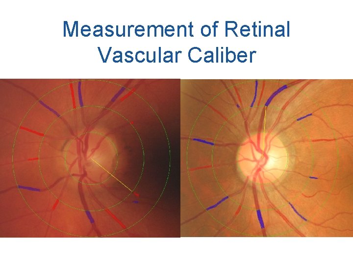 Measurement of Retinal Vascular Caliber 