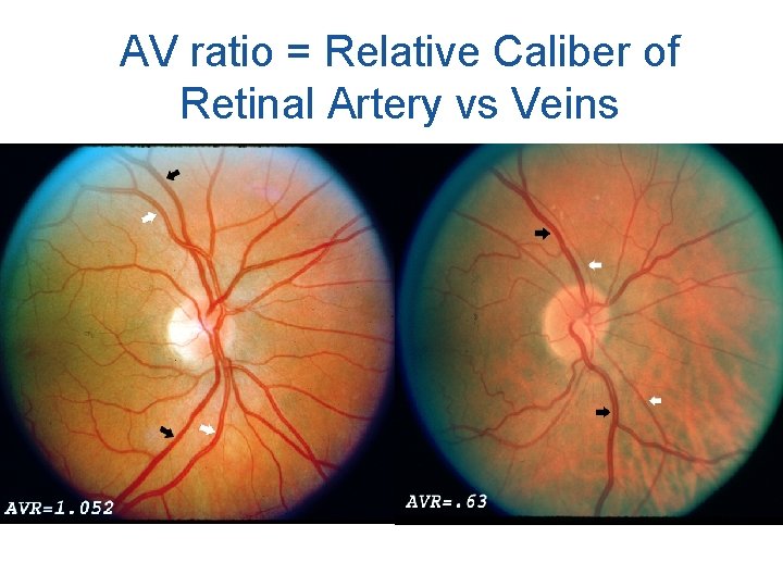 AV ratio = Relative Caliber of Retinal Artery vs Veins 