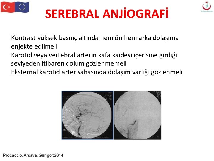 SEREBRAL ANJİOGRAFİ Kontrast yüksek basınç altında hem ön hem arka dolaşıma enjekte edilmeli Karotid SEREBRAL ANJİOGRAFİ Kontrast yüksek basınç altında hem ön hem arka dolaşıma enjekte edilmeli Karotid