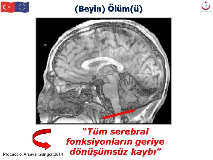 (Beyin) Ölüm(ü) “Tüm serebral fonksiyonların geriye dönüşümsüz kaybı” (Beyin) Ölüm(ü) “Tüm serebral fonksiyonların geriye dönüşümsüz kaybı”