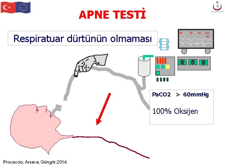 APNE TESTİ Respiratuar dürtünün olmaması 130 78 23 130 98 Pa. CO 2 > APNE TESTİ Respiratuar dürtünün olmaması 130 78 23 130 98 Pa. CO 2 >