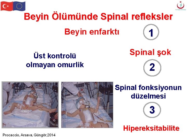 Beyin Ölümünde Spinal refleksler Beyin enfarktı Üst kontrolü olmayan omurlik 1 Spinal şok 2 Beyin Ölümünde Spinal refleksler Beyin enfarktı Üst kontrolü olmayan omurlik 1 Spinal şok 2