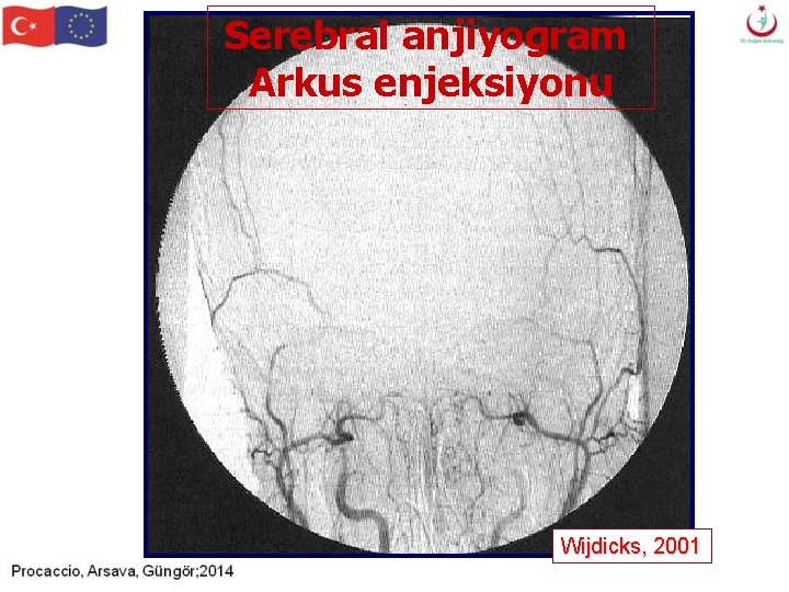 Serebral anjiyogram Arkus enjeksiyonu Wijdicks, 2001 Serebral anjiyogram Arkus enjeksiyonu Wijdicks, 2001