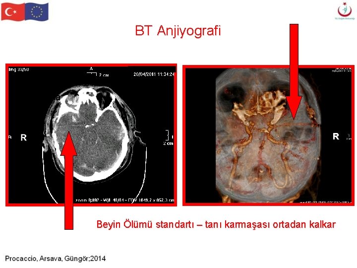 BT Anjiyografi Girlanda R Beyin Ölümü standartı – tanı karmaşası ortadan kalkar BT Anjiyografi Girlanda R Beyin Ölümü standartı – tanı karmaşası ortadan kalkar