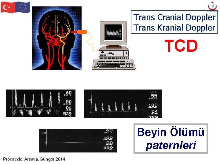 Trans Cranial Doppler Trans Kranial Doppler TCD Beyin Ölümü paternleri Trans Cranial Doppler Trans Kranial Doppler TCD Beyin Ölümü paternleri