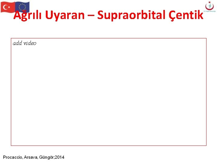 Ağrılı Uyaran – Supraorbital Çentik add video Ağrılı Uyaran – Supraorbital Çentik add video