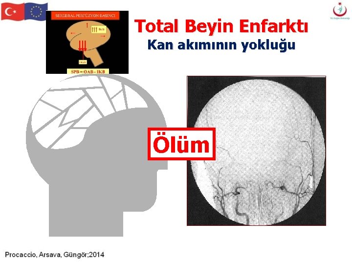 Total Beyin Enfarktı Kan akımının yokluğu Ölüm Total Beyin Enfarktı Kan akımının yokluğu Ölüm