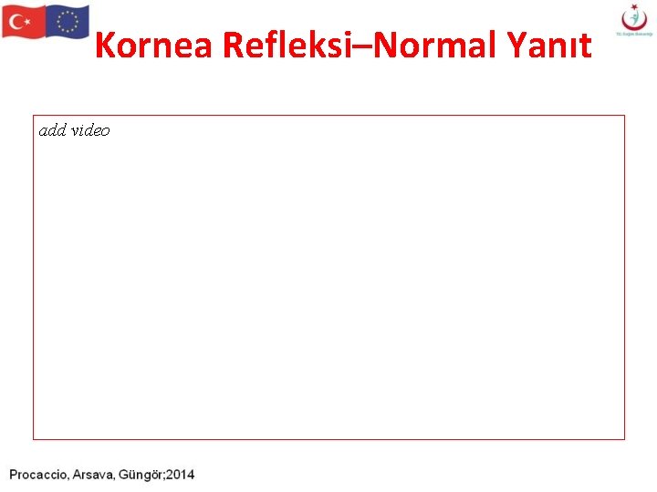 Kornea Refleksi–Normal Yanıt add video Kornea Refleksi–Normal Yanıt add video