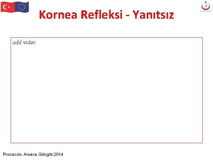 Kornea Refleksi - Yanıtsız add video Kornea Refleksi - Yanıtsız add video