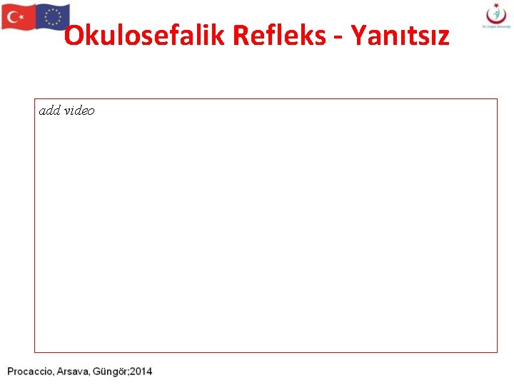 Okulosefalik Refleks - Yanıtsız add video Okulosefalik Refleks - Yanıtsız add video