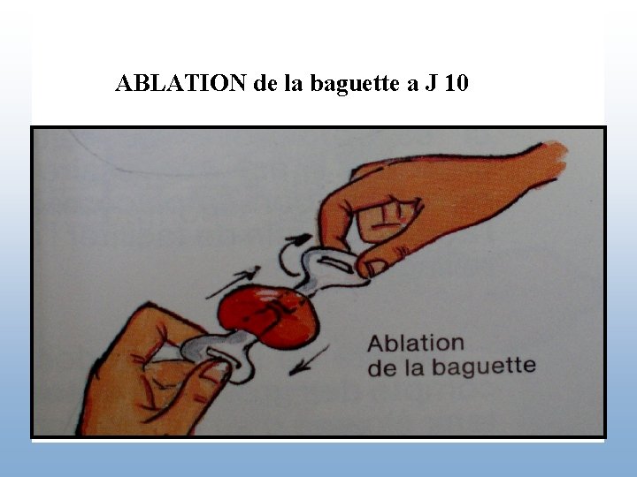 ABLATION de la baguette a J 10 