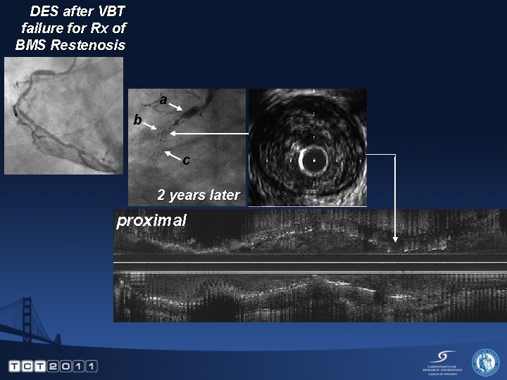 DES after VBT failure for Rx of BMS Restenosis a b c 2 years