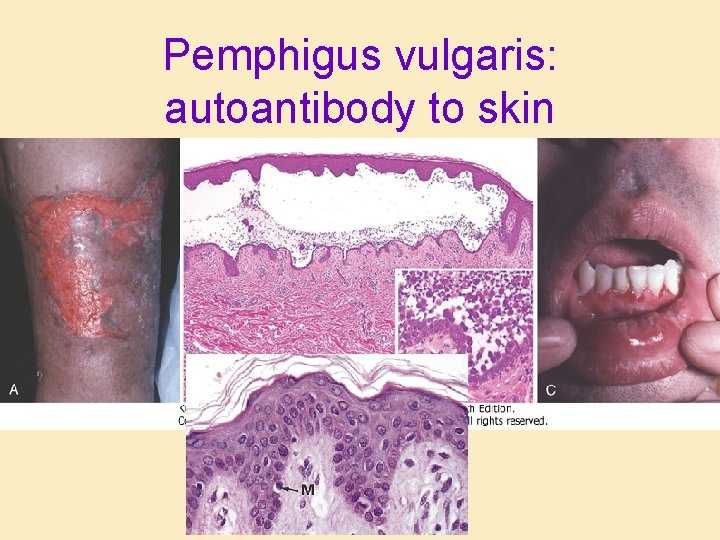 Pemphigus vulgaris: autoantibody to skin 