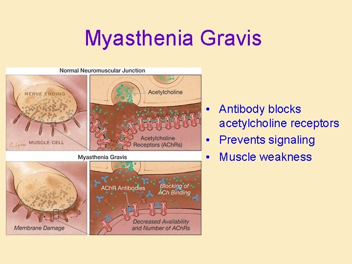 Myasthenia Gravis • Antibody blocks acetylcholine receptors • Prevents signaling • Muscle weakness 