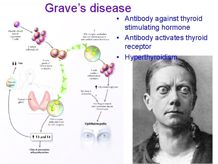 Grave’s disease • Antibody against thyroid stimulating hormone • Antibody activates thyroid receptor •