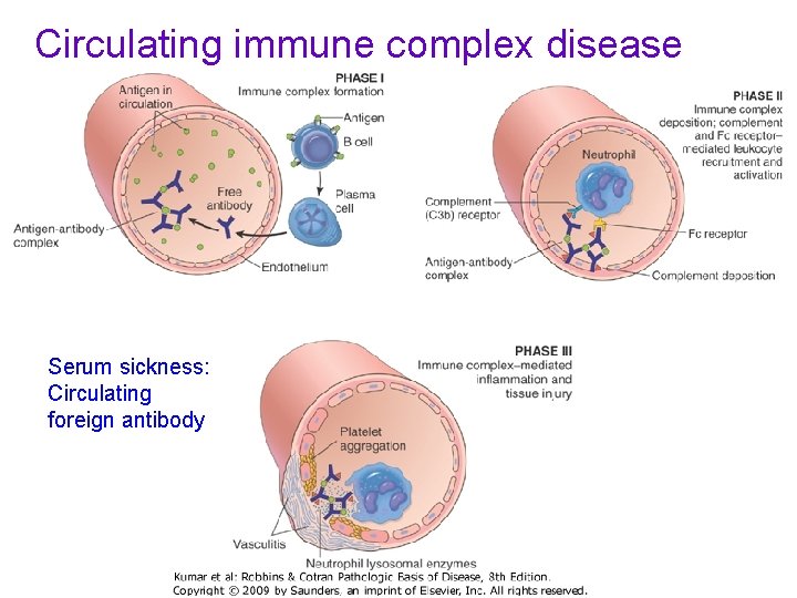 Circulating immune complex disease Serum sickness: Circulating foreign antibody 