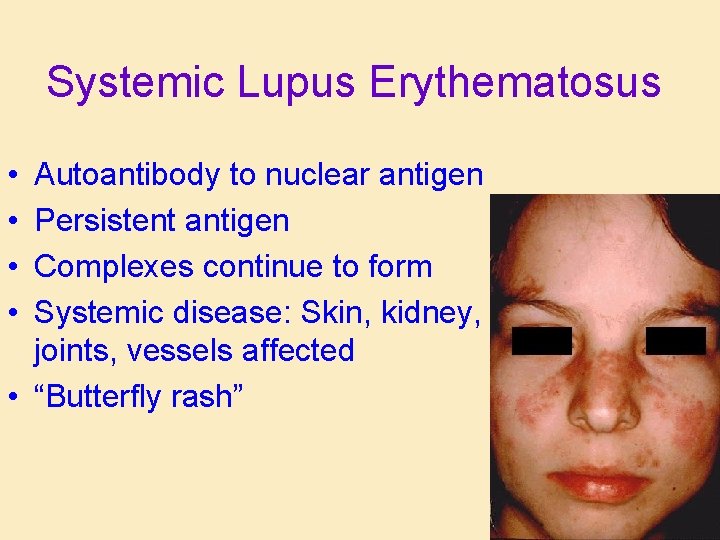 Systemic Lupus Erythematosus • • Autoantibody to nuclear antigen Persistent antigen Complexes continue to