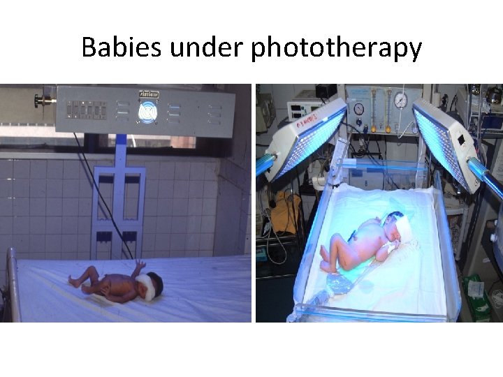 Babies under phototherapy Baby under conventional phototherapy Baby under triple unit intense phototherapy 