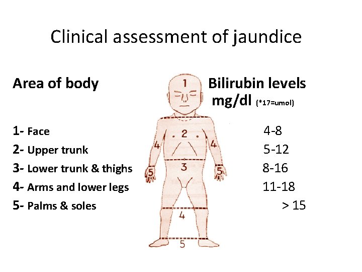 Clinical assessment of jaundice Area of body Bilirubin levels mg/dl (*17=umol) 1 - Face