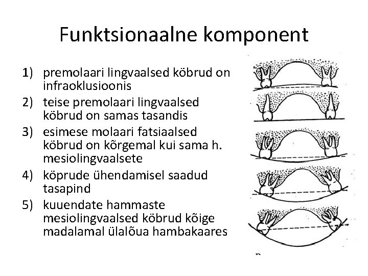 Funktsionaalne komponent 1) premolaari lingvaalsed köbrud on infraoklusioonis 2) teise premolaari lingvaalsed köbrud on