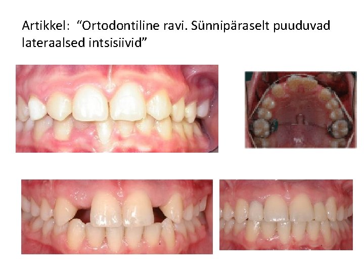 Artikkel: “Ortodontiline ravi. Sünnipäraselt puuduvad lateraalsed intsisiivid” 