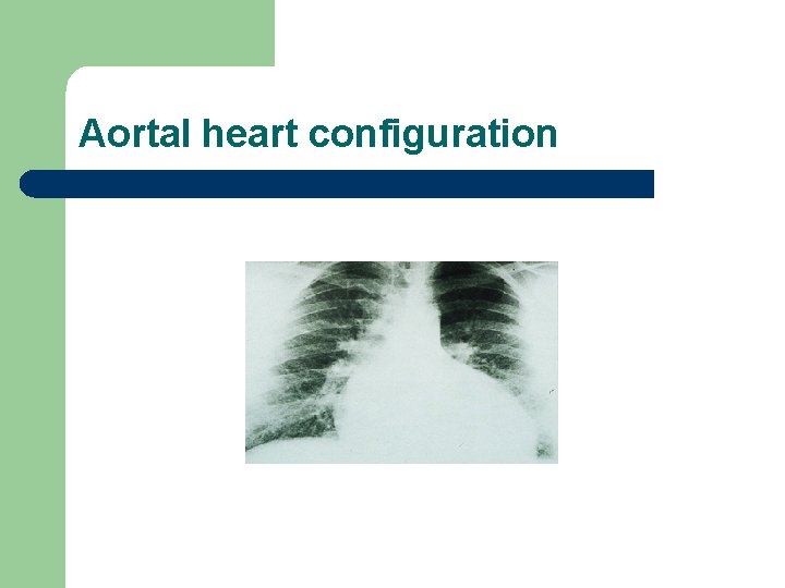 Aortal heart configuration 