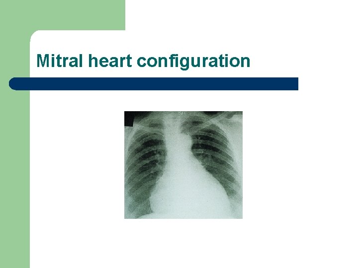 Mitral heart configuration 