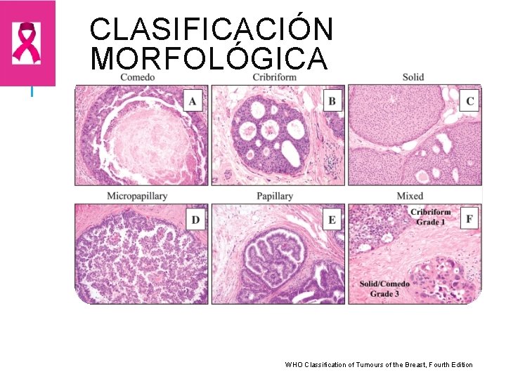 CLASIFICACIÓN MORFOLÓGICA WHO Classification of Tumours of the Breast, Fourth Edition 