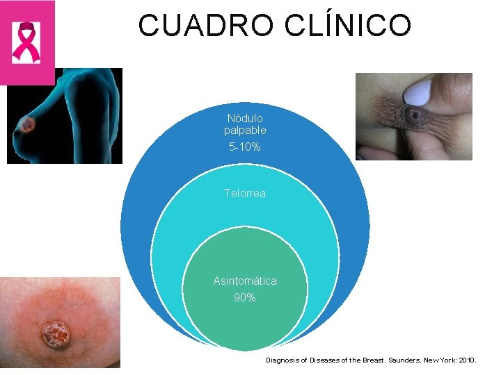 CUADRO CLÍNICO Nódulo palpable 5 -10% Telorrea Asintomática 90% Diagnosis of Diseases of the